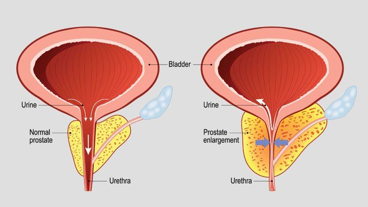 How an Enlarged Prostate Can Affect Your Urinary Health