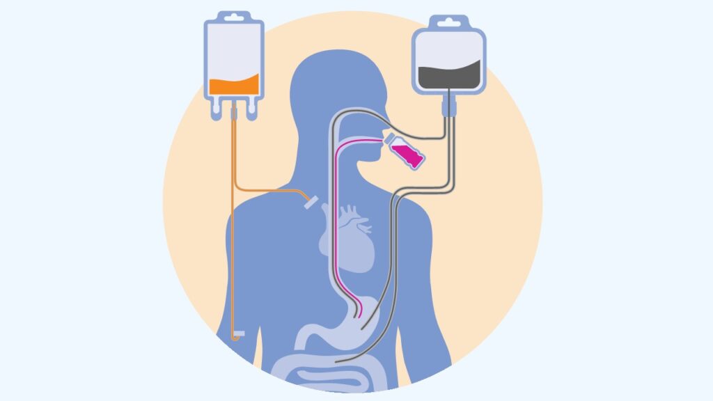 What Is Home Enteral Nutrition?