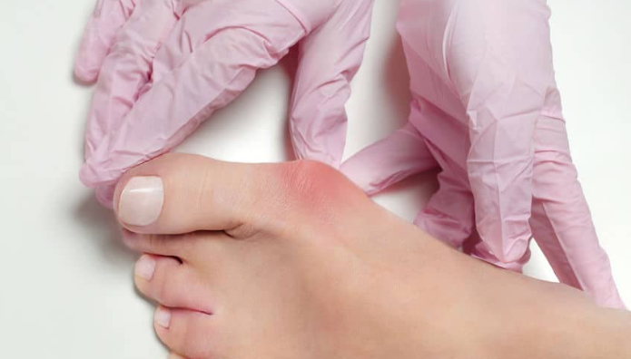 How Podiatrists Treat Bunions and Hammertoes