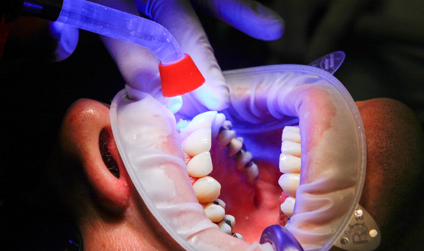 Treatment Options for Cracked Teeth with an Endodontic Specialist