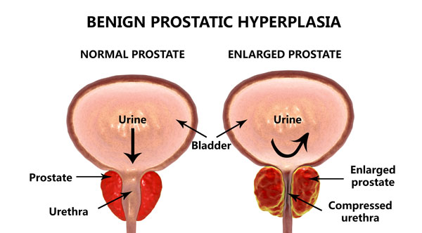 The Link Between Enlarged Prostate and Urinary Incontinence