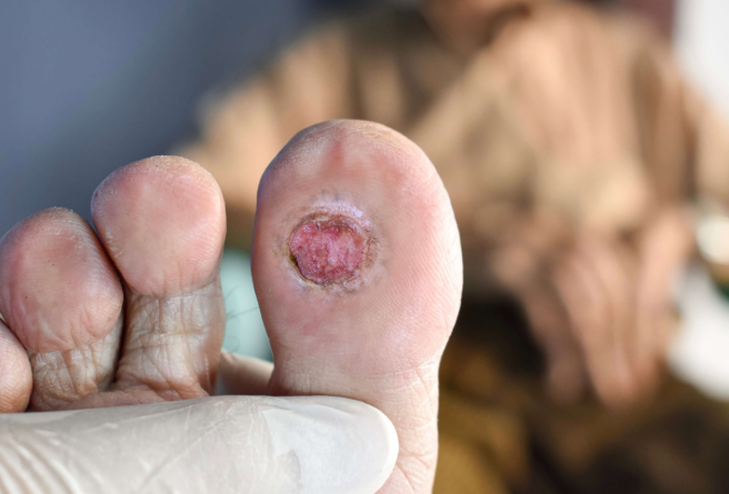 Essential Wound Care Techniques for Chronic Foot Problems