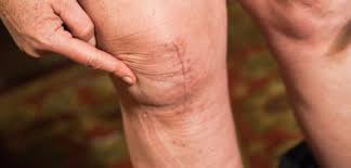 Common Questions About Psoriatic Arthritis