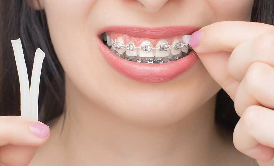 How to Care for Braces