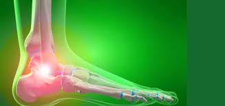 The Link Between Plantar Fasciitis and Heel Spurs
