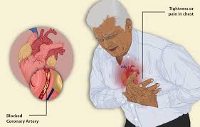 When Chest Pain Is a Sign of a Serious Heart Condition