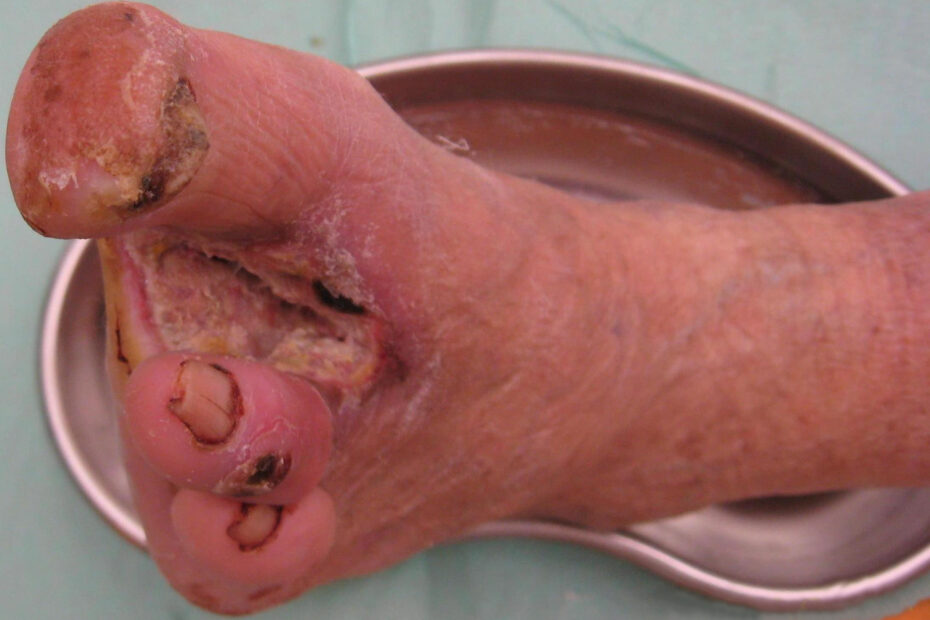 Wound Care for Diabetic Patients