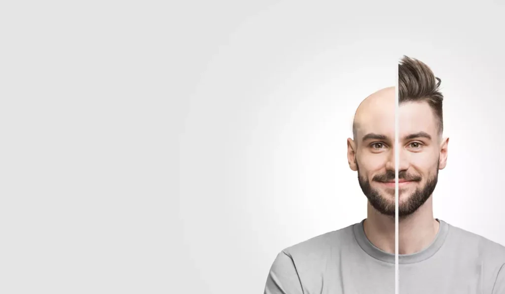 5 Benefits of a Hair Transplant