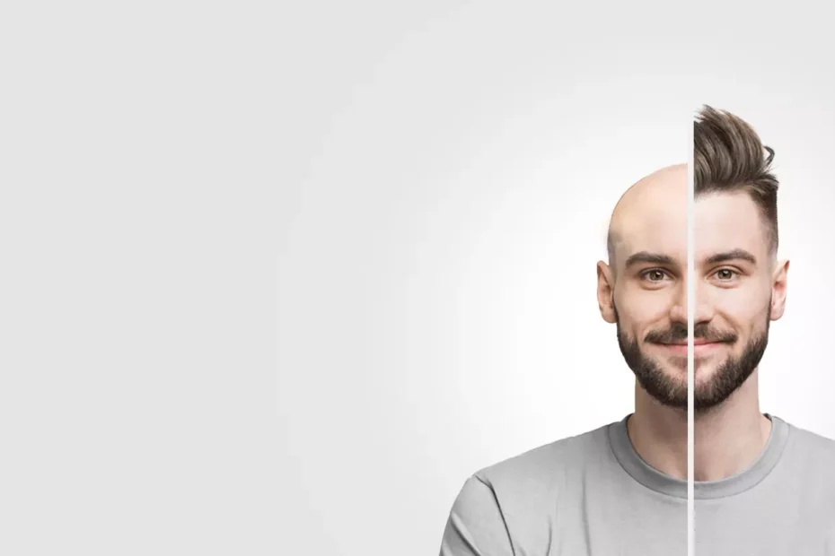 5 Benefits of a Hair Transplant