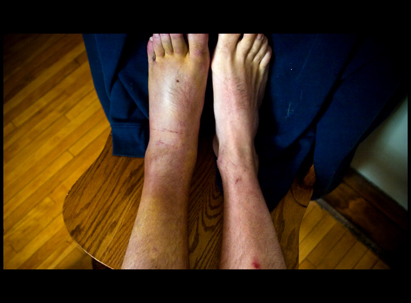 How an Ankle Replacement Can Improve Your Health