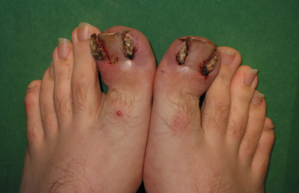 Signs You May Have Toe Nail Fungus and What To Do