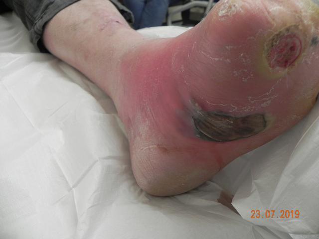 The Importance of Diabetic Wound Care in Preventing Complications